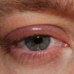 Blefaritis, Peradangan Kelopak Mata yang Sering Di Abaikan