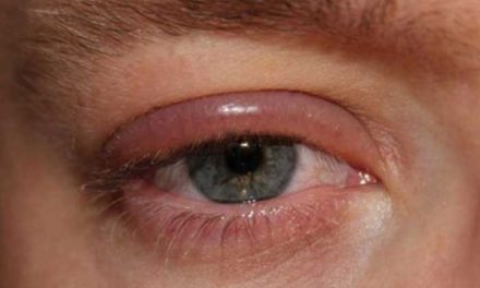 Blefaritis, Peradangan Kelopak Mata yang Sering Di Abaikan