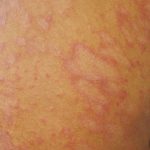 Penyakit Tinea Infeksi Kulit Di Sebabkan Oleh Jamur Dermatofit