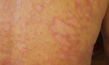 Penyakit Tinea Infeksi Kulit Di Sebabkan Oleh Jamur Dermatofit