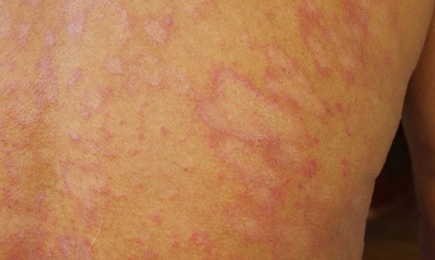 Penyakit Tinea Infeksi Kulit Di Sebabkan Oleh Jamur Dermatofit
