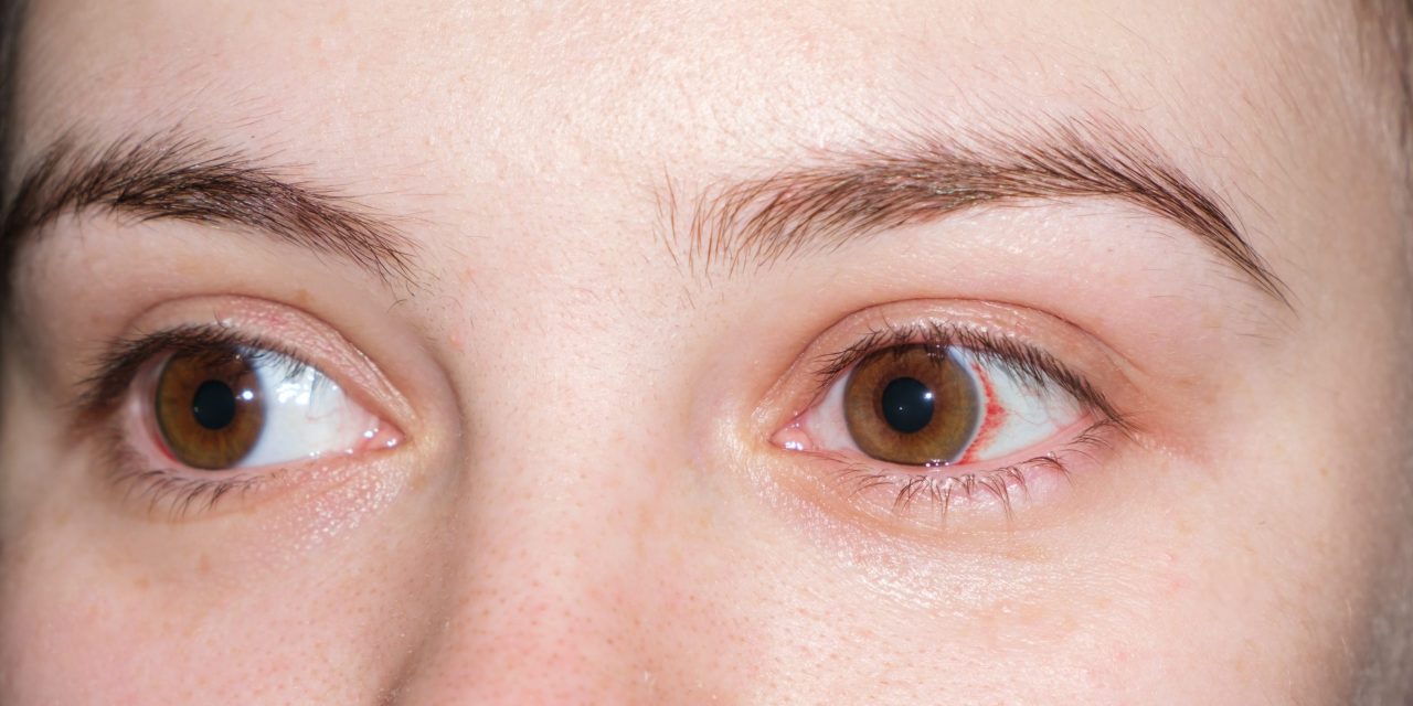 Xerophthalmia, Gangguan Mata Akibat Kekurangan Vitamin A