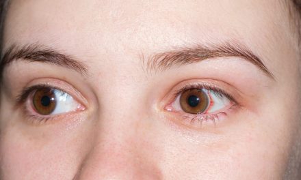 Xerophthalmia, Gangguan Mata Akibat Kekurangan Vitamin A