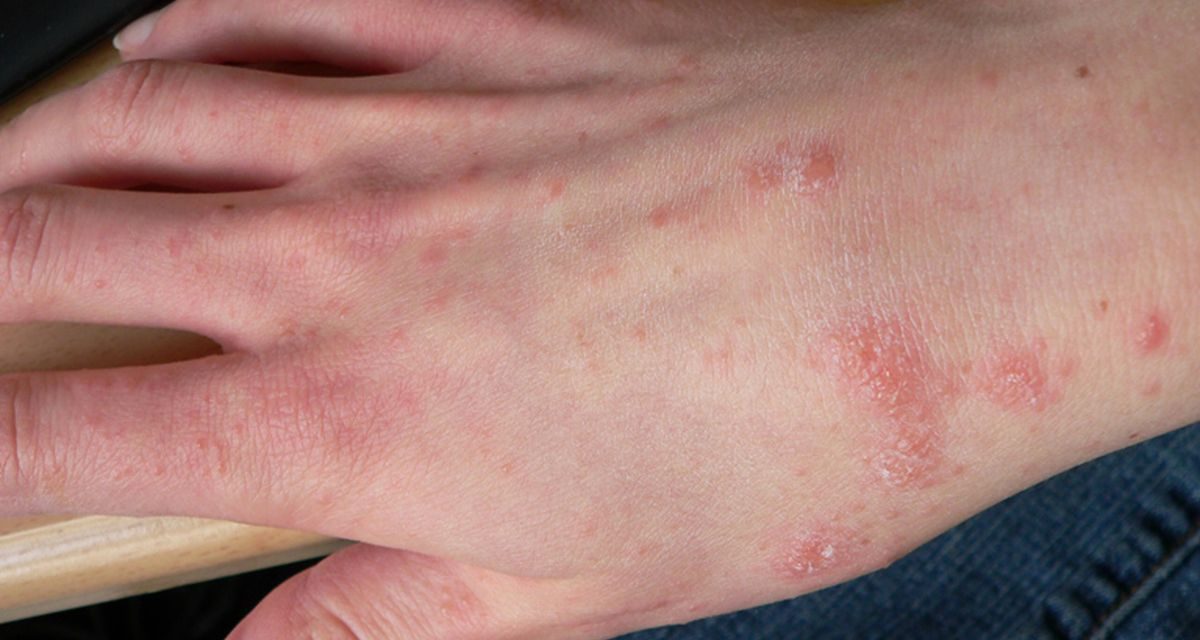 Penyakit Kudis Di Sebabkan Oleh Tungau Mikroskopis