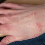 Penyakit Kudis Di Sebabkan Oleh Tungau Mikroskopis