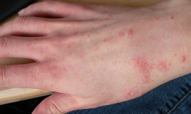 Penyakit Kudis Di Sebabkan Oleh Tungau Mikroskopis