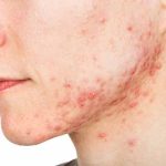 Cara Mengobati Cystic Acne Secara Bertahap Dan Rutin