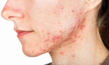 Cara Mengobati Cystic Acne Secara Bertahap Dan Rutin