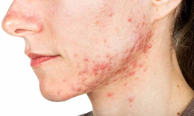 Cara Mengobati Cystic Acne Secara Bertahap Dan Rutin